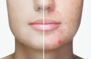 How to fight hyperpigmentation around the mouth?