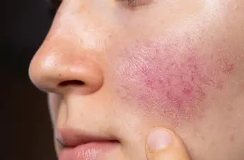 Here are 8 steps on how to easily treat acne at home