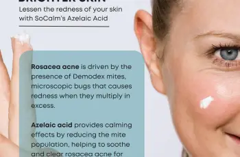 Why Azelaic Acid is a Go-To for Rosacea Treatment