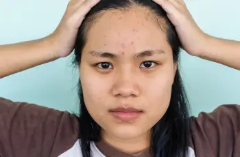 Ask the Dermatologist: 4 Common Lies You’ve Been Told About Acne