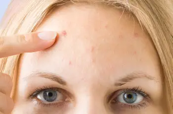 Dermatologist’s Advice: Is It Safe to Pop Pimples?