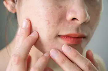 What Are the Best Ingredients to Treat Acne?