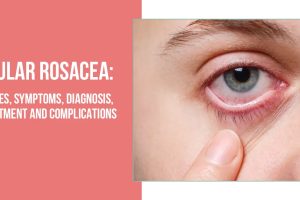 What is Ocular Rosacea? Understanding Its Symptoms and Causes