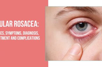 What is Ocular Rosacea? Understanding Its Symptoms and Causes