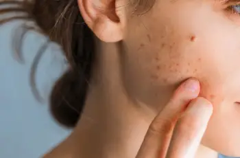 7 Reasons Why White Bumps Appear on Your Skin and How to Fix Them