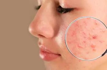 Fungal Acne Could This Be Causing Your Persistent Pimples