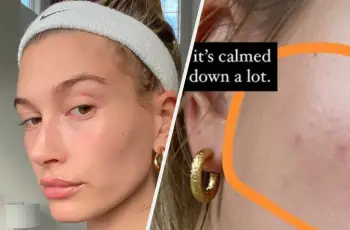 Hailey Bieber Just Shared Her Skin-Care Routine for Perioral Dermatitis