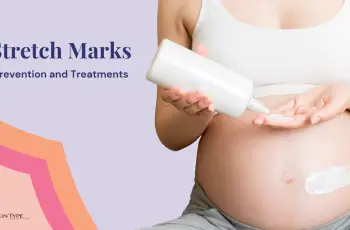 Stretch Marks: Prevention and Treatment