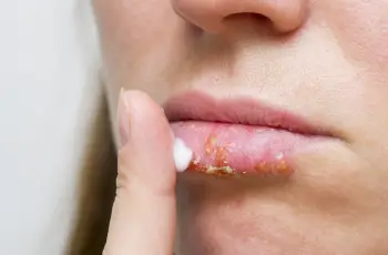 Chapped Lips vs Cold Sores: How to Tell What You’re Dealing With