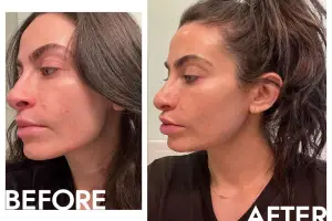 I Tried AviClear—A New Laser Treatment For Acne—And It Made a Big Difference