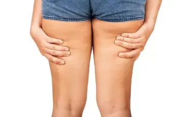 7 Ways to Deal With Thigh Chafing, According to Dermatologists