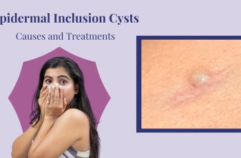 Epidermal Inclusion Cyst: Causes, Symptoms, and Treatment