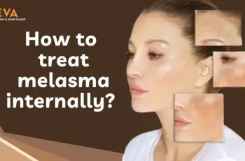 How To Treat Melasma From The Inside