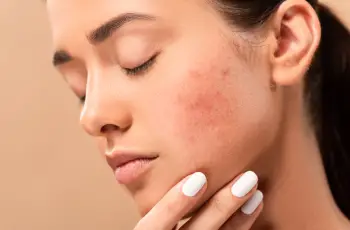 How long does it take to get rid of acne?