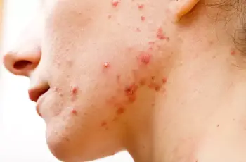 Cystic acne: Causes, symptoms, and treatments