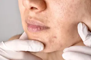 What Causes Clogged Pores and Comedones?