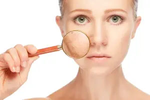 How To Get Rid of Melasma