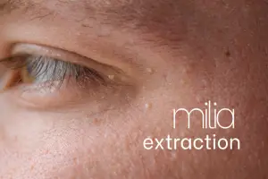 How to get rid of milia: Treatment, prevention, and causes