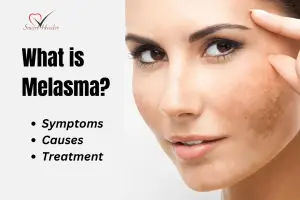 Melasma: Symptoms, Diagnosis, and Treatments