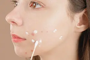 Benzoyl peroxide for acne: Side effects and benefits