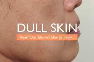 What is Dull Skin & What are the Causes?