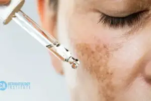 Best Treatment For Melasma on the Face