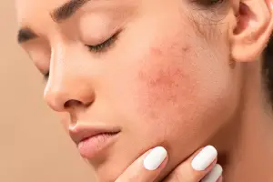 Eczema Symptoms, Causes, and Treatment