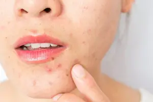 What Causes Acne?