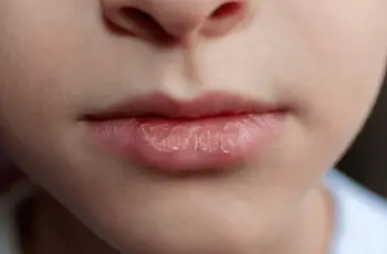 How to Fix Dry, Flaky Skin Around the Mouth Fast