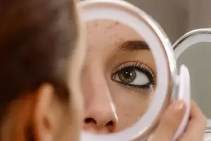8 Simple Home Remedies to Get Rid of Acne Fast
