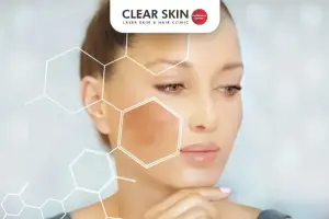 Holistic Approach to Melasma: Diet, Supplements, and Skincare