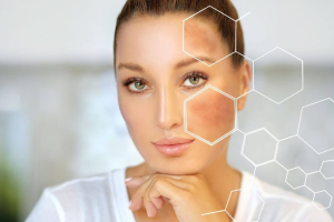 Post-Inflammatory Hyperpigmentation (PIH): Causes, Treatments, and Skin Care Tips