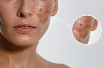 How Inflammation Triggers Hyperpigmentation and What Skincare Can Do How Inflammation Triggers Hyperpigmentation and What Skincare Can Do