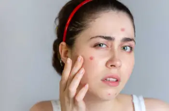 Should You Pop Your Pimple? A Dermatologist’s Guide to Skin Health
