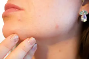 Dermatologists Explain Causes and Treatments for Ear Acne