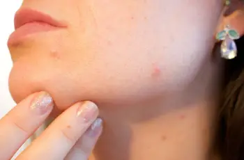 Dermatologists Explain Causes and Treatments for Ear Acne Dermatologists Explain Causes and Treatments for Ear Acne