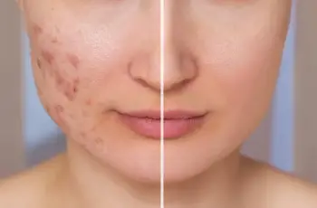 The Best Way to Treat Acne Scabs The Best Way to Treat Acne Scabs