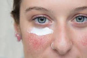 Using Tretinoin and Azelaic Acid Together: Benefits and Tips for Clearer Skin