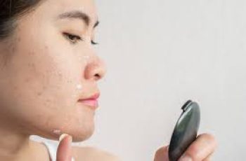 Skincare After Sunburn: Should You Use Azelaic Acid? Skincare After Sunburn: Should You Use Azelaic Acid?