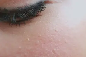 White Bumps on Skin? 7 Reasons and What To Do