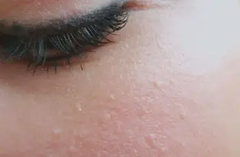 White Bumps on Skin? 7 Reasons and What To Do White Bumps on Skin? 7 Reasons and What To Do