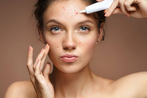 How Hyaluronic Acid Helps Acne-Prone Skin Stay Hydrated