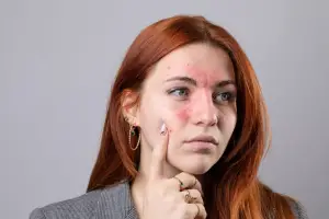 Understanding Ocular Rosacea: Symptoms, Causes, and Effective Treatments