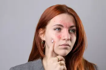 Understanding Ocular Rosacea: Symptoms, Causes, and Effective Treatments