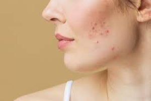 Comprehensive Guide to Understanding and Treating Cystic Acne