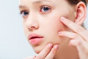 How Long Does Acne Take to Heal With Proper Skincare?