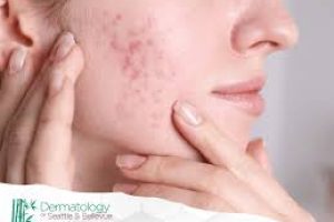 Effective Dermal Fillers: Minimally Invasive Acne Scar Skin Care