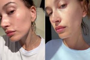 Skincare Tips from Hailey Bieber for Perioral Dermatitis Relief