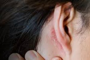 How to Treat Dry Ear Skin: A Skincare Guide