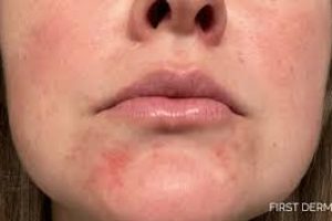 Dry Skin Around the Mouth: Causes, Prevention Tips, and Effective Treatments for Relief
